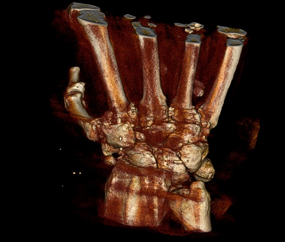 Coronal Opaque - Gorilla Hand.jpg