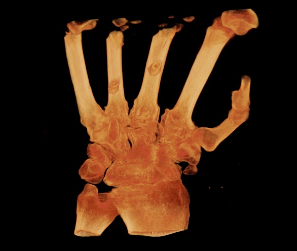 Coronal Transparent - Gorilla Hand.jpg