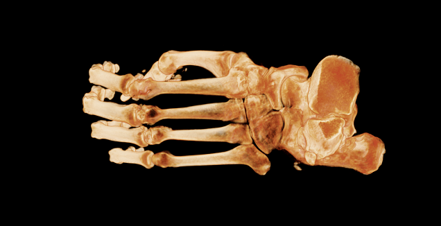 view 4 bones of foot top-down.png